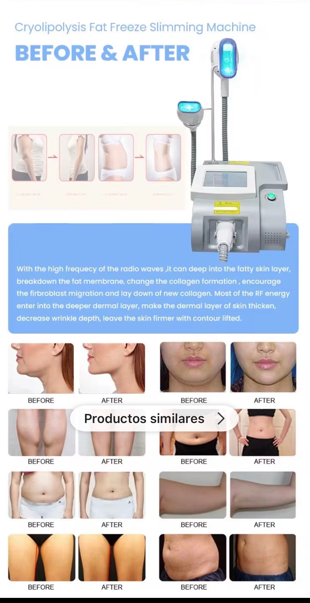 Máquina de Criolipólisis en Frío 3 Manerales – Quema de Grasa Localizada y Lifting Facial sin Cirugía